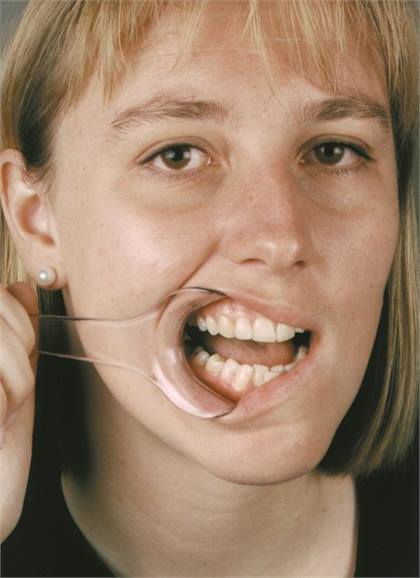 Mirahold Cheek Retractor, Adult, 2/Pk, 605450 thumbnail 13